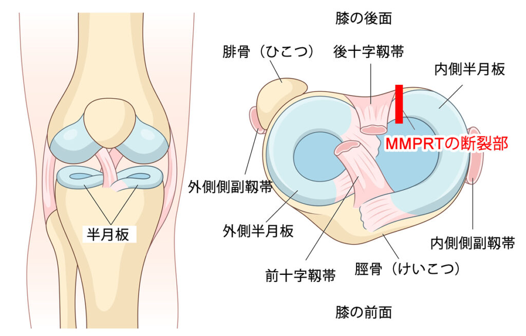MMPRTの断裂部