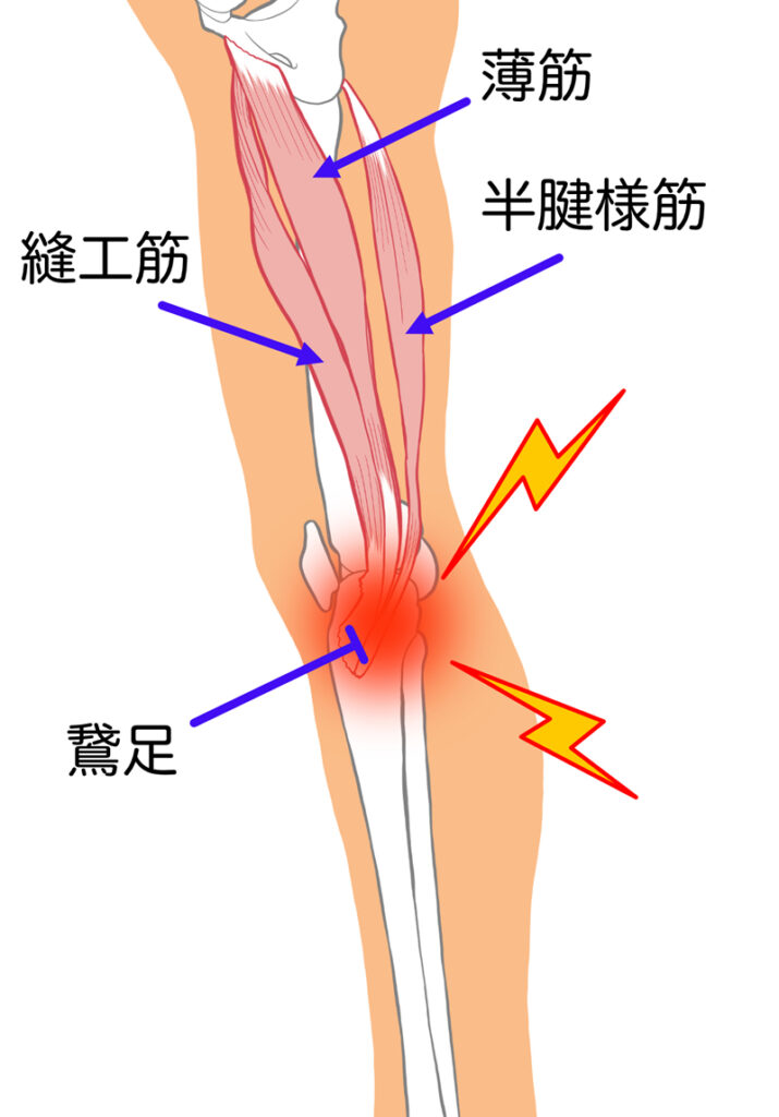 鵞足炎（がそくえん）