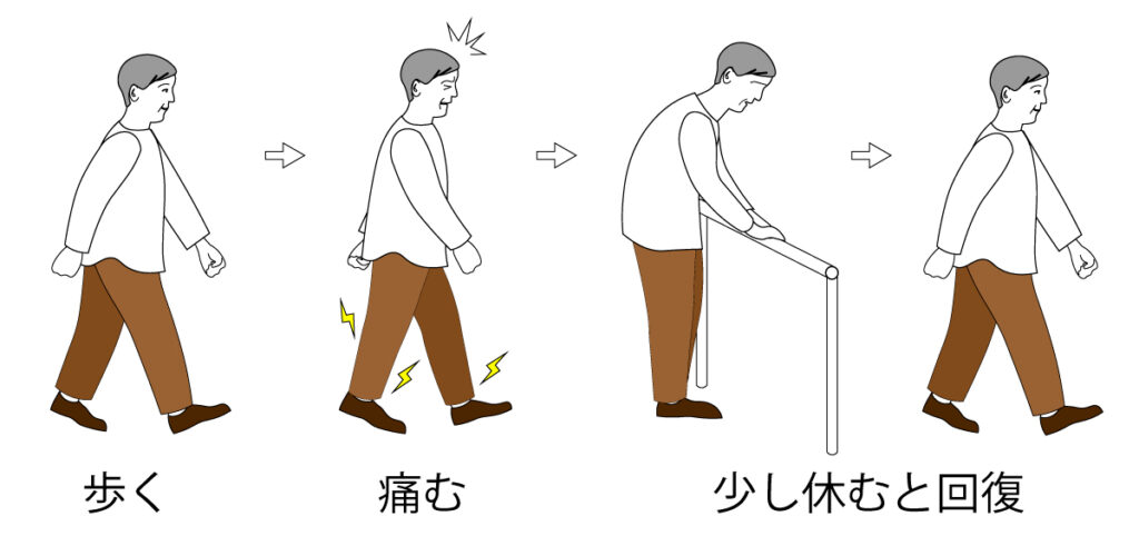 間欠性跛行