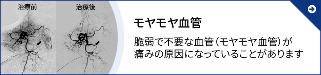 モヤモヤ血管 脆弱で不要な血管(モヤモヤ血管)が
痛みの原因になっていることがあります