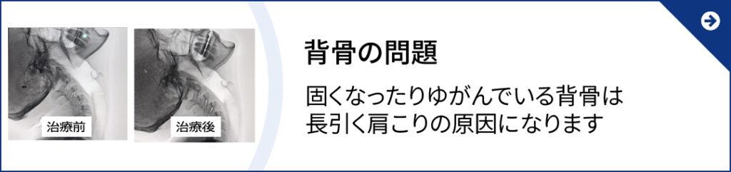 背骨の病院 固くなったりゆがんでいる背骨は長引く肩こりの原因になります